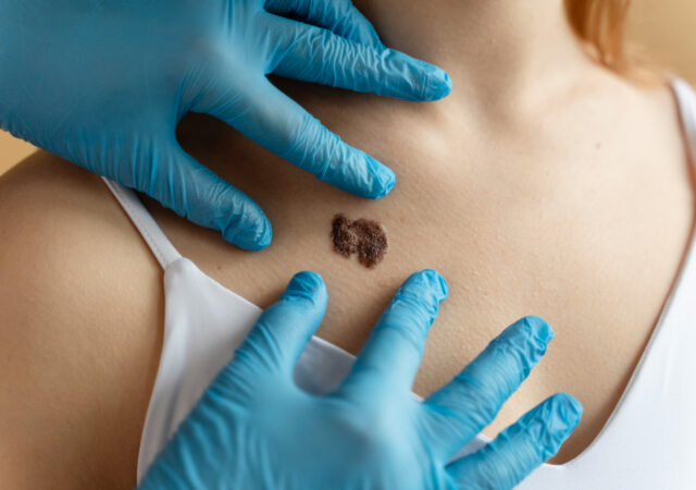Skin Mole on Back